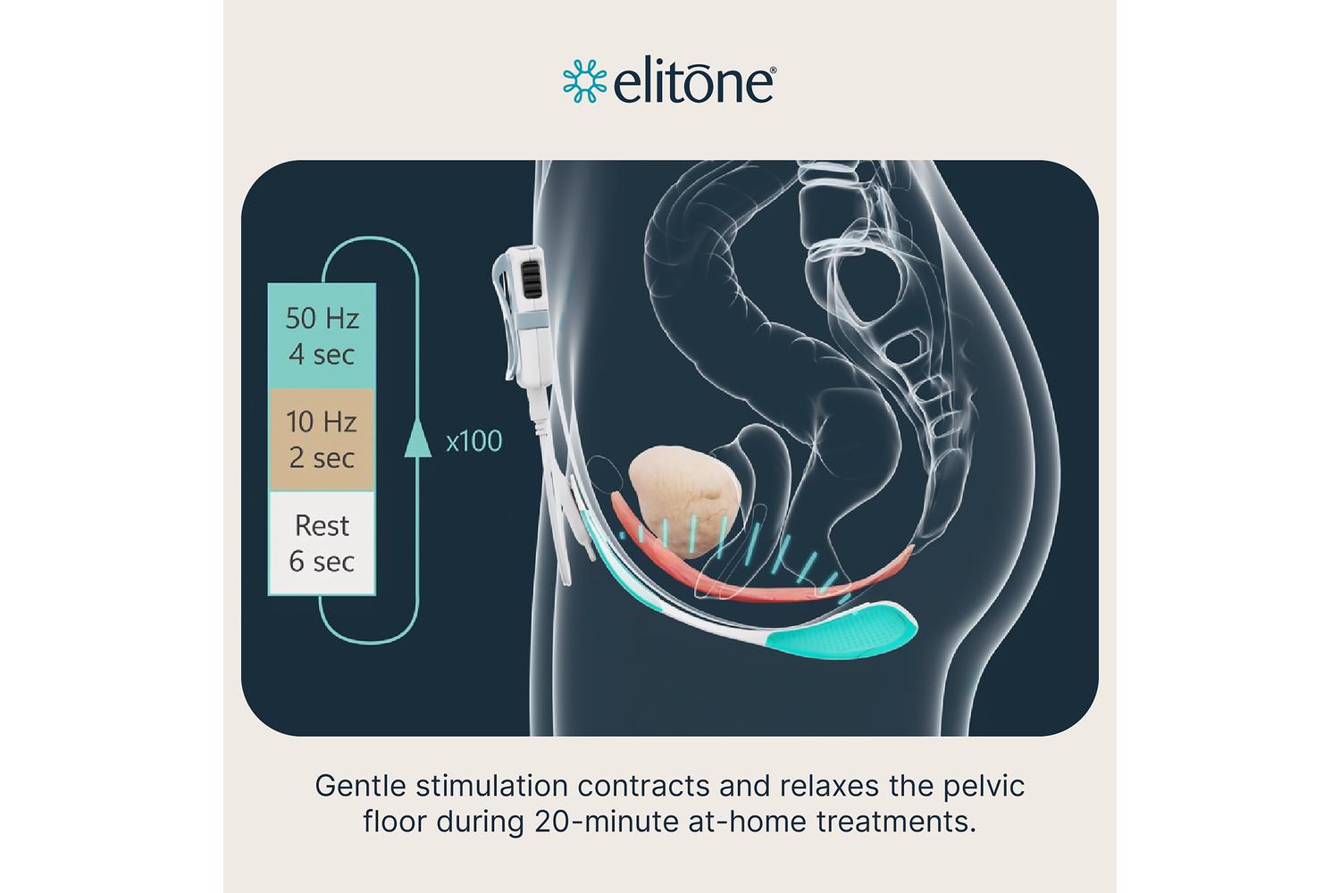 Elitone Female Incontinence Therapy Kit-6