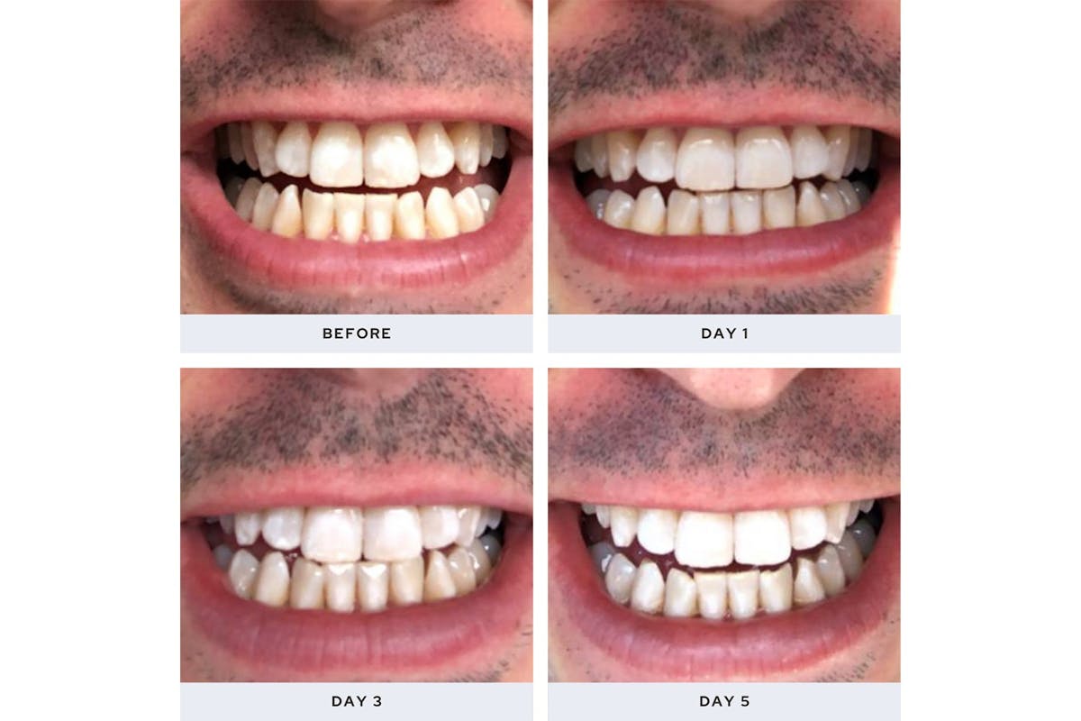 Spotlight Professional LED Teeth Whitening System | LEDSYSTEM-12