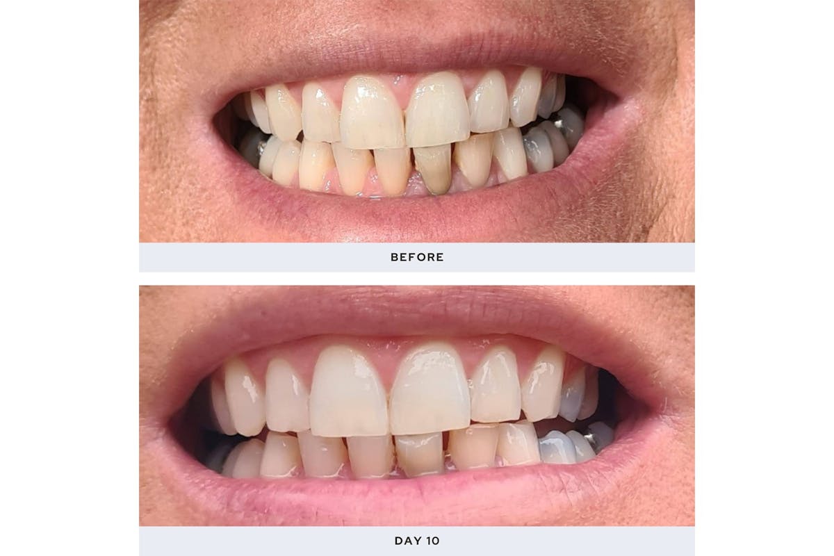 Spotlight Professional LED Teeth Whitening System | LEDSYSTEM-11