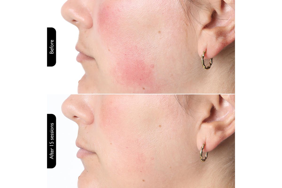 Silk'n LED Face Mask | FLM100PUK001-9